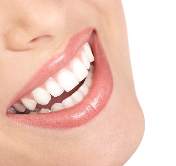 take-home teeth whitening